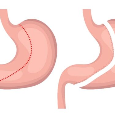 gastric sleeve surgery cost Brisbane