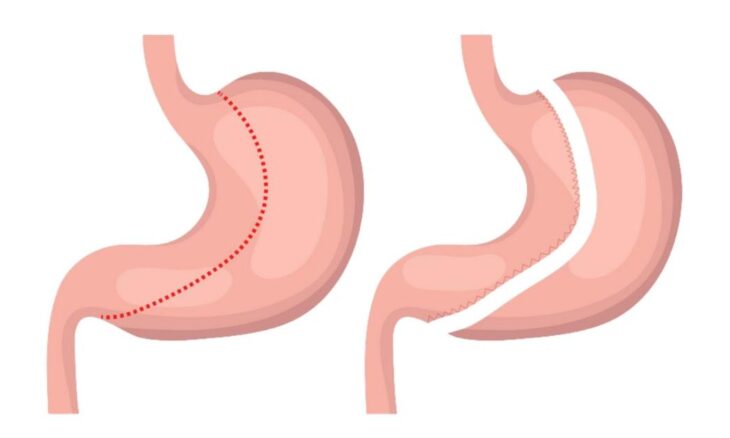 gastric sleeve surgery cost Brisbane